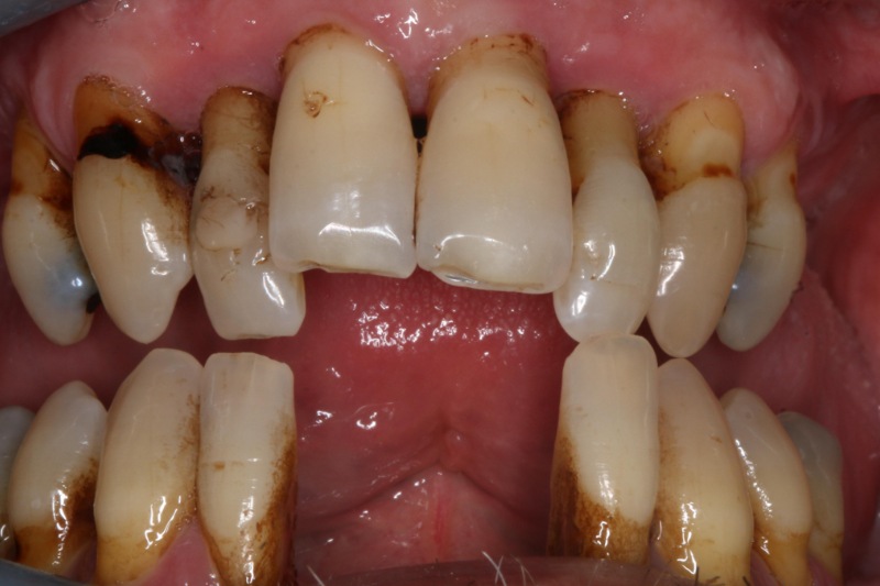 Before Full Mouth Restoration