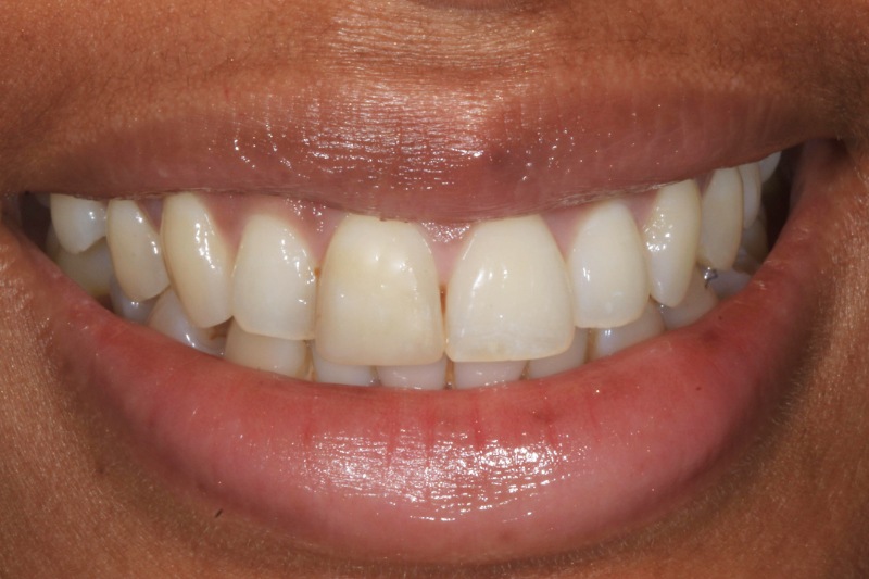 Charlene Composite After