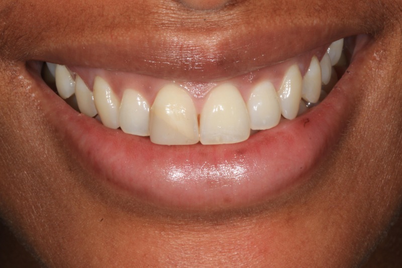 Charlene Composite Before