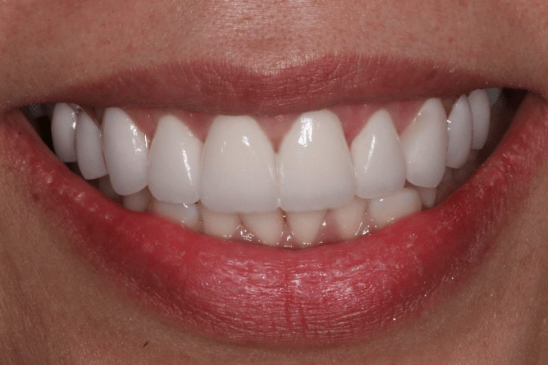 Chloe Veneers After