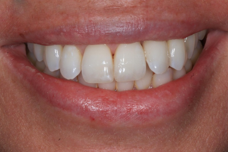 Composite Bonding After