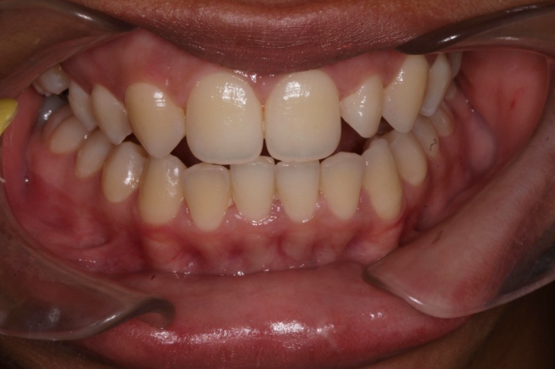 Composite C black Composite C Black