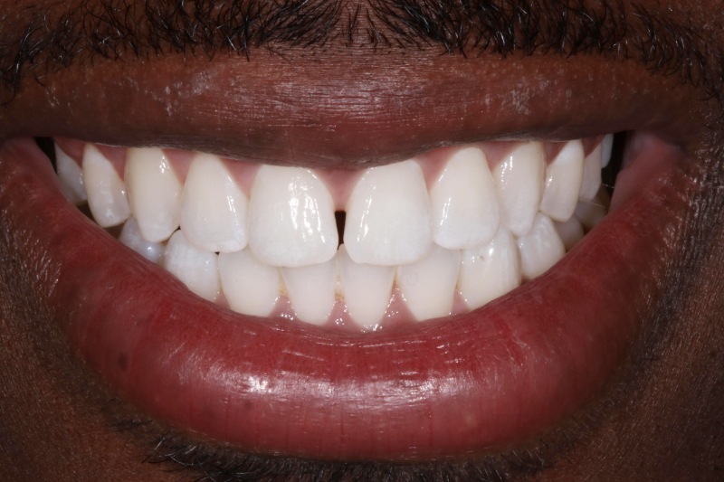 Composite Jumani B Composite Jumani B