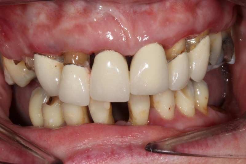 Implants Christina B