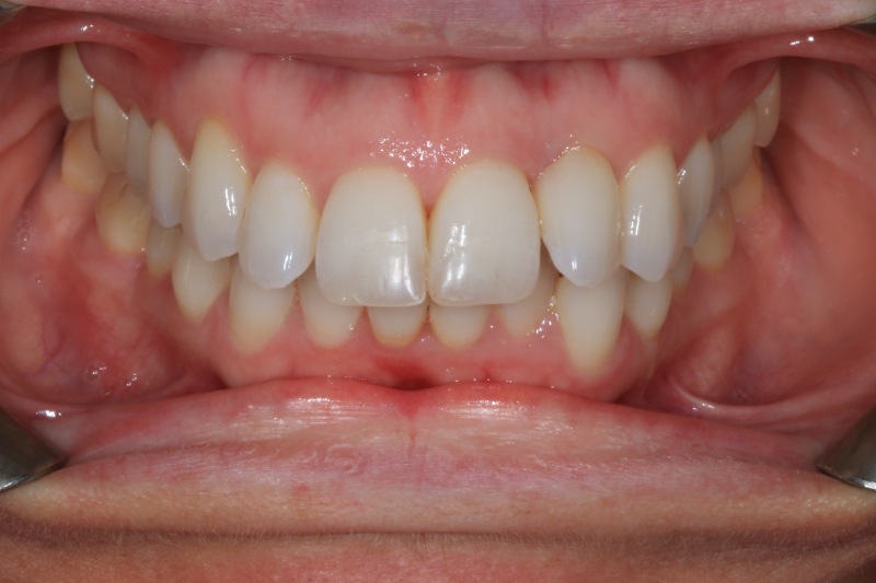 Composite And Invisalign A