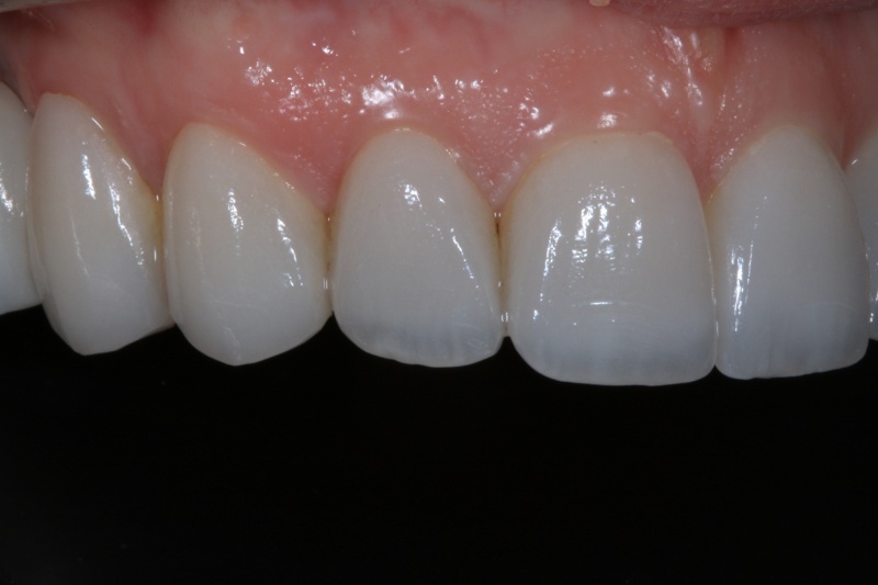 Sophie Smile Design Left