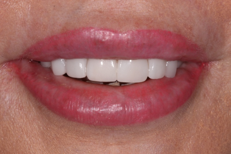 Justyna Veneers A