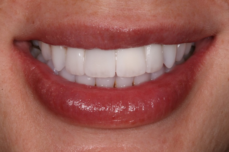 Joelle Veneers After