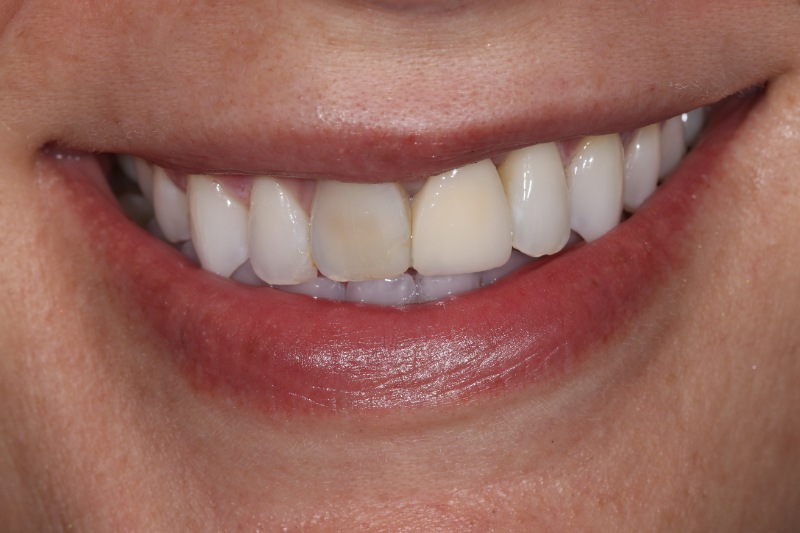 Joelle Veneers B