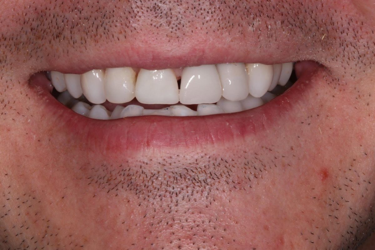 Dave Implant And Crown After