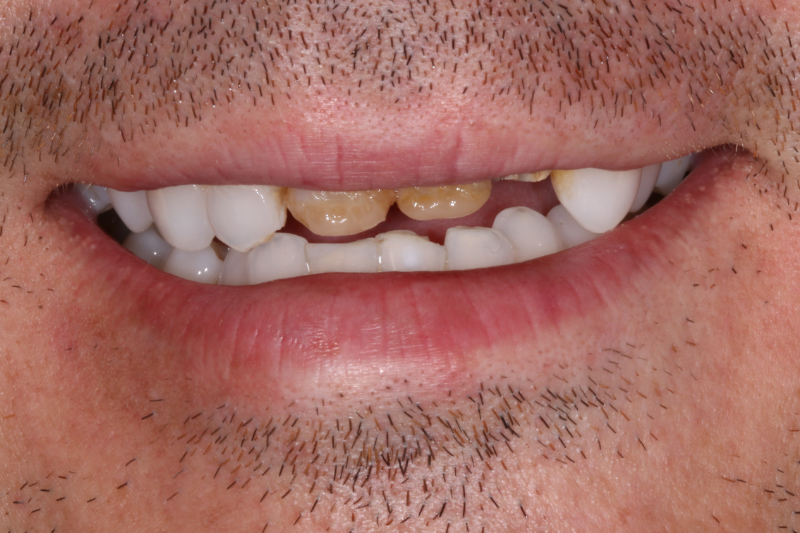 Dave Implant And Crown Before
