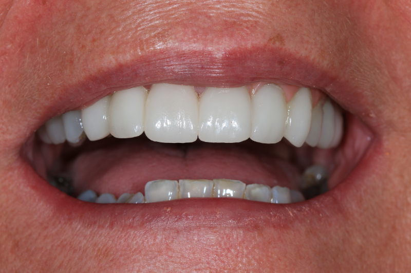 Sue Veneers Implant Bridge A