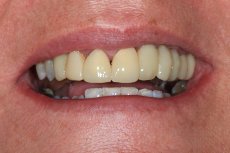 Sue Veneers Implant Bridge B