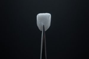 non-cutting veneer Dental Artistry DaVinci Veneers