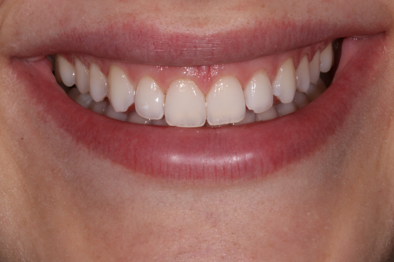 Jois After Gum Contour