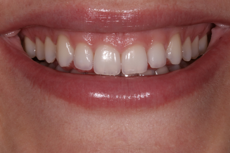 Jois Before Gum Contour