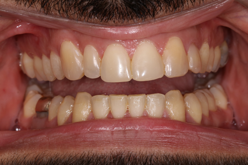 Pamesh Fixed Braces After