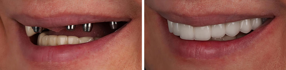 all on 4 dental implants before after