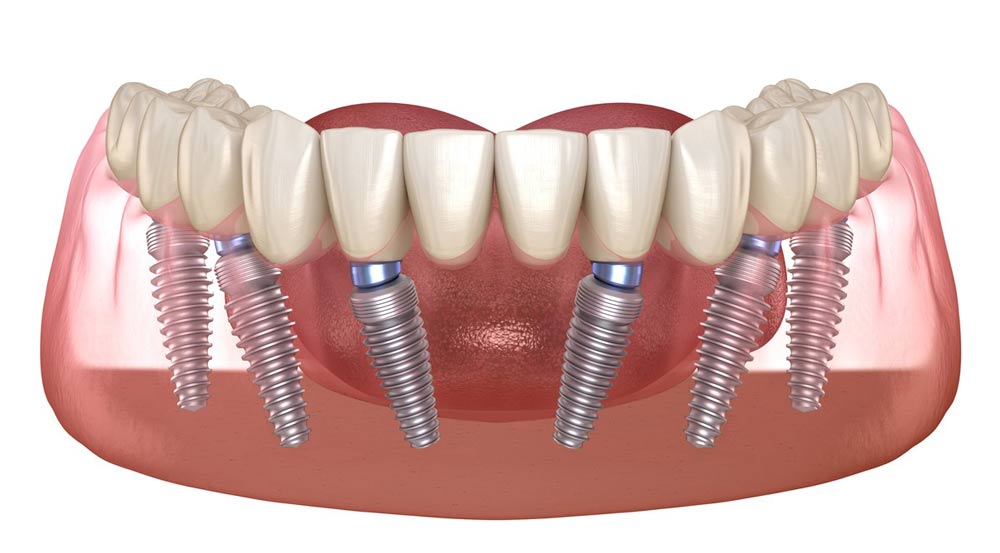 how-do-implant-retained-dentures-work what are dental implants retained dentures