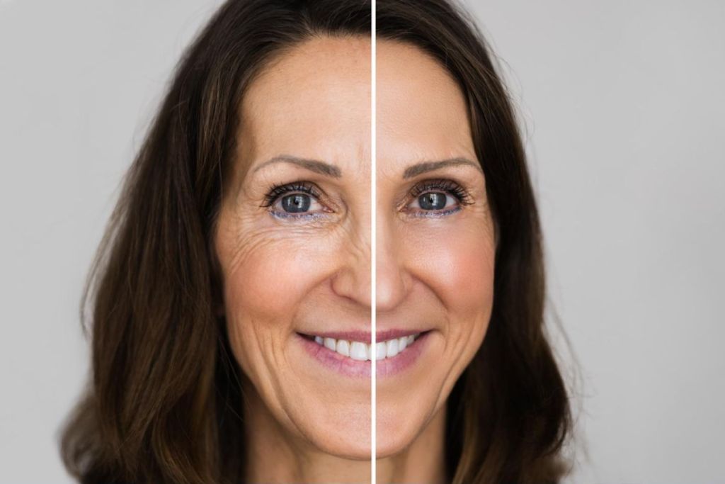 Anti Wrinkle Treatment London 14