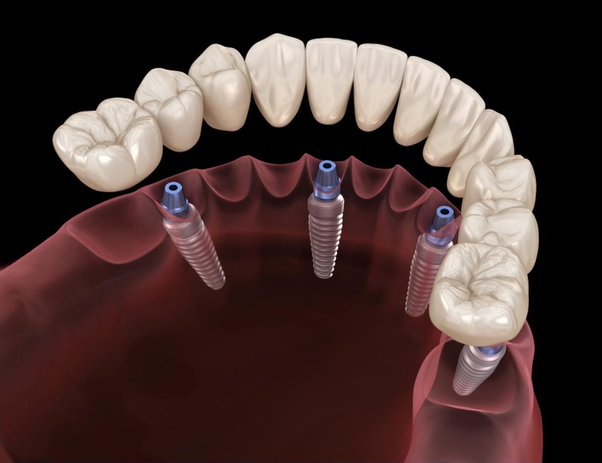 full mouth dental implants cost