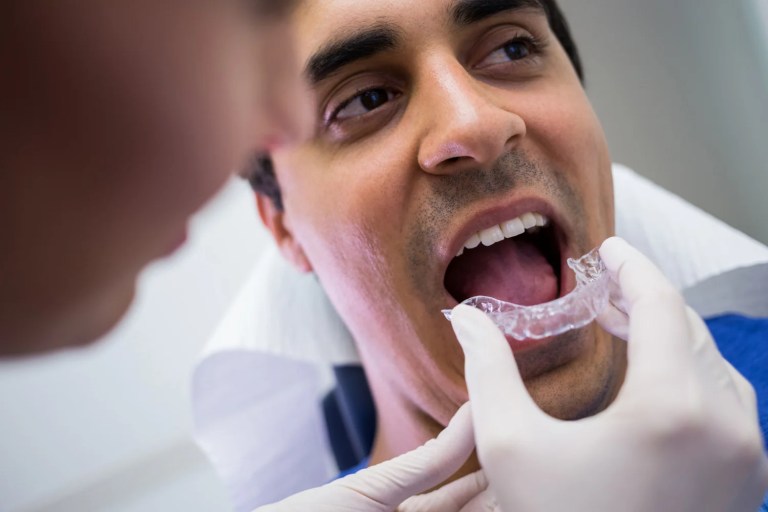 Invisalign Lite Uk