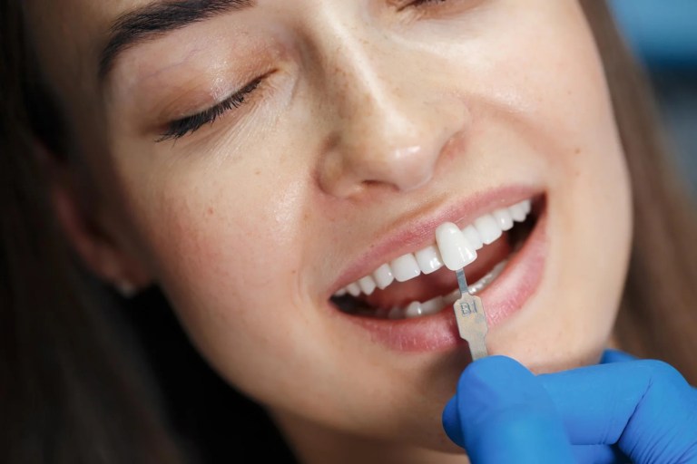 Full Set Of Veneers Cost Uk