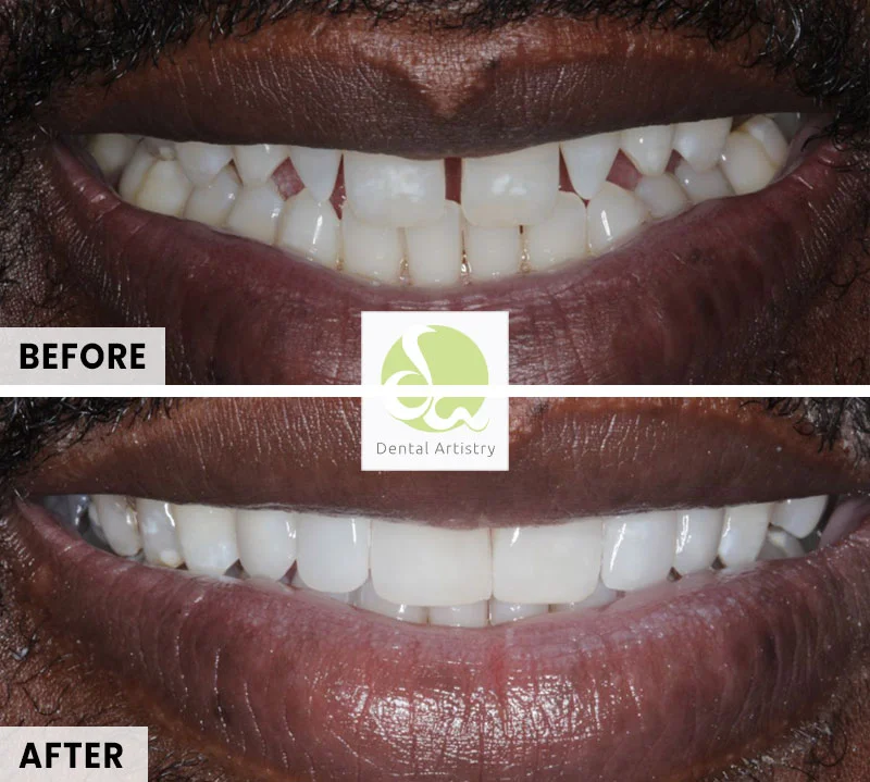 Composite Bonding Before After 1