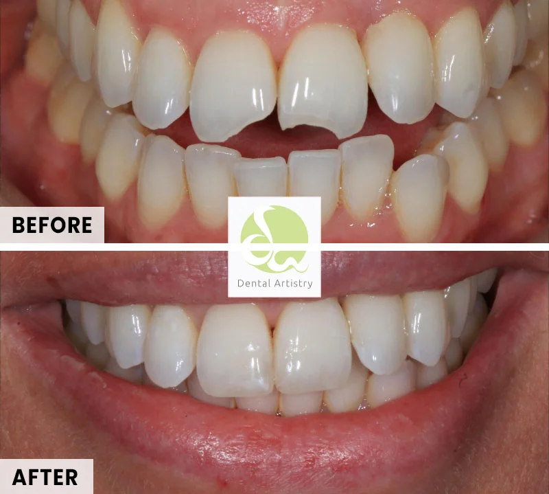 Composite Bonding Before After 1b