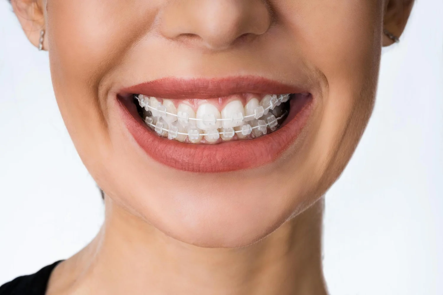 Ceramic Braces Dentist London